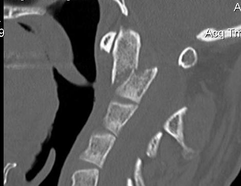Type 2 Dens Fracture Displaced